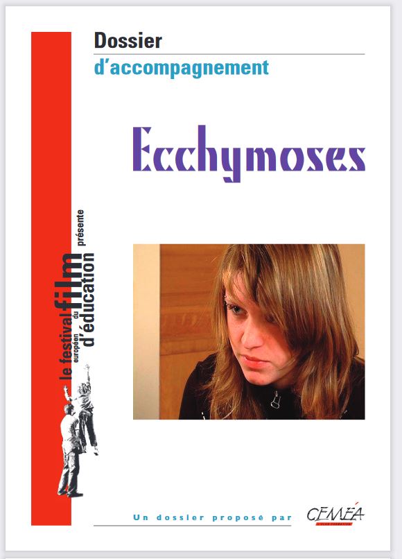 Ecchymoses